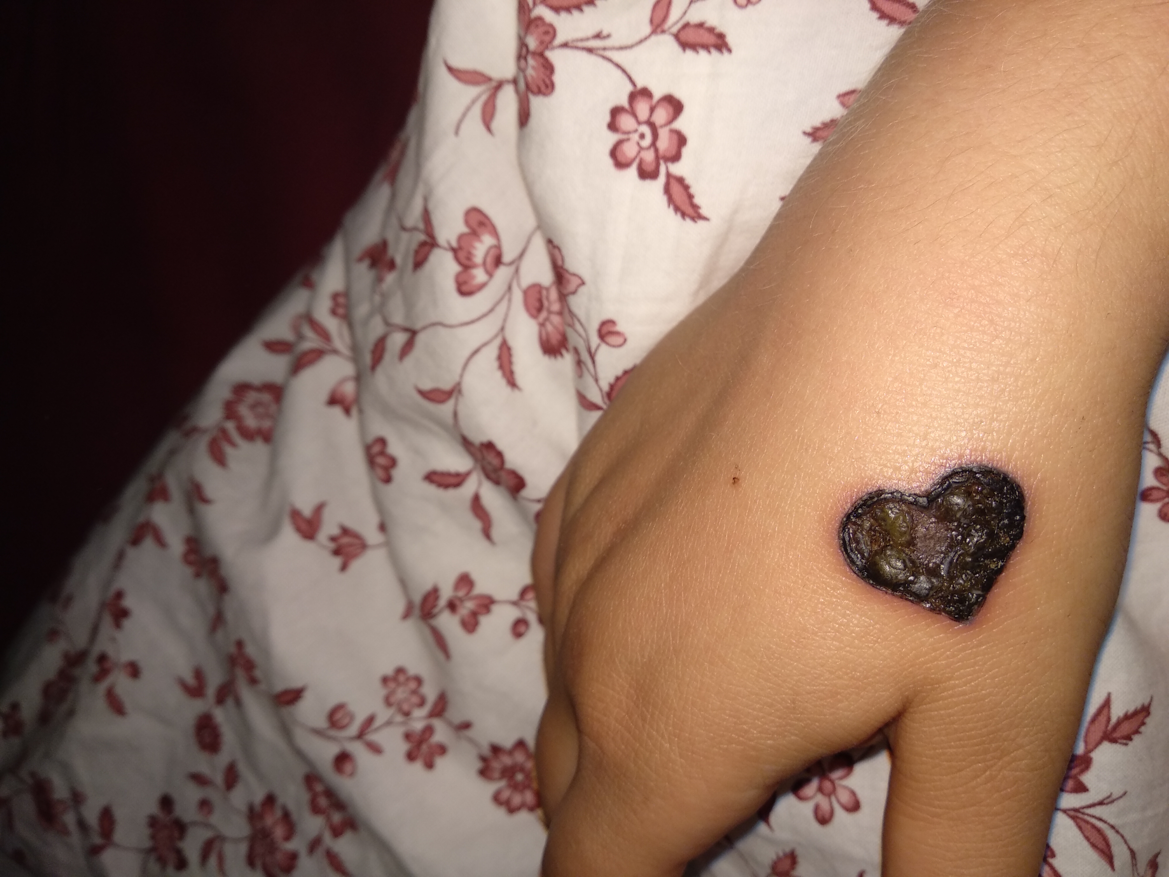 Sieht die Kruste an meinem Tattoo normal aus? (Gesundheit und Medizin