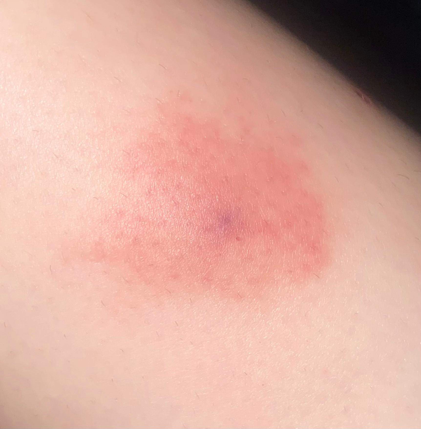 Sieht dieser Mückenstich normal aus? (Medizin, Insekten, Stich)