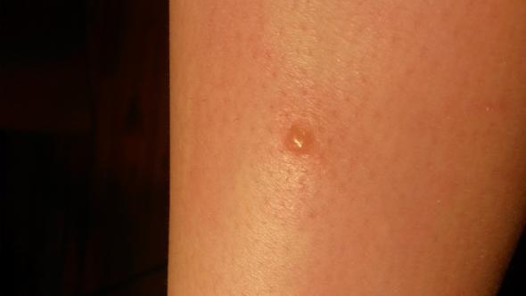 Sieht Dieser Zeckenbiss Normal Aus Foto Krankheit Zecke