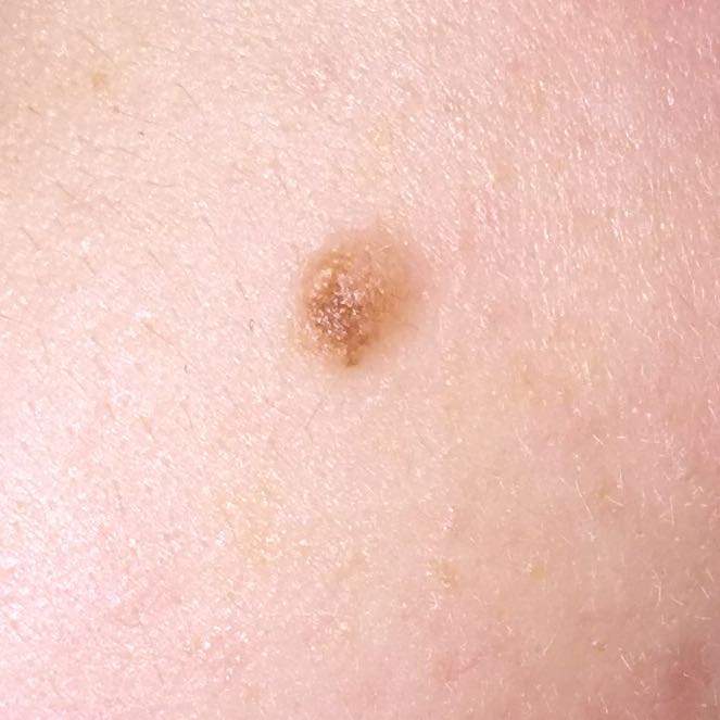 Sieht dieses Muttermal vielleicht gefährlich aus? (Gesundheit, Haut, Dermatologie)