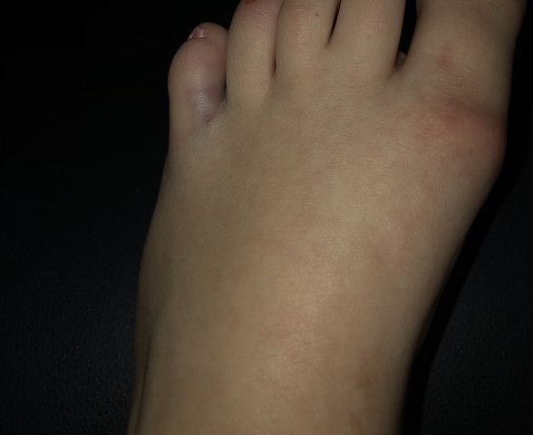 Sieht Es Aus Als Ob Mein Kleiner Zeh Gebrochen Ist Arzt Sieht Es Aus Als Ob Mein Kleiner Zeh Gebrochen Ist Arzt