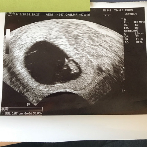 Ultraschall frühschwangerschaft  - (schwanger, Ultraschall)