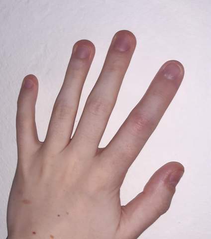 Sieht jeder Finger bei einer Sehnenverletzung so aus?