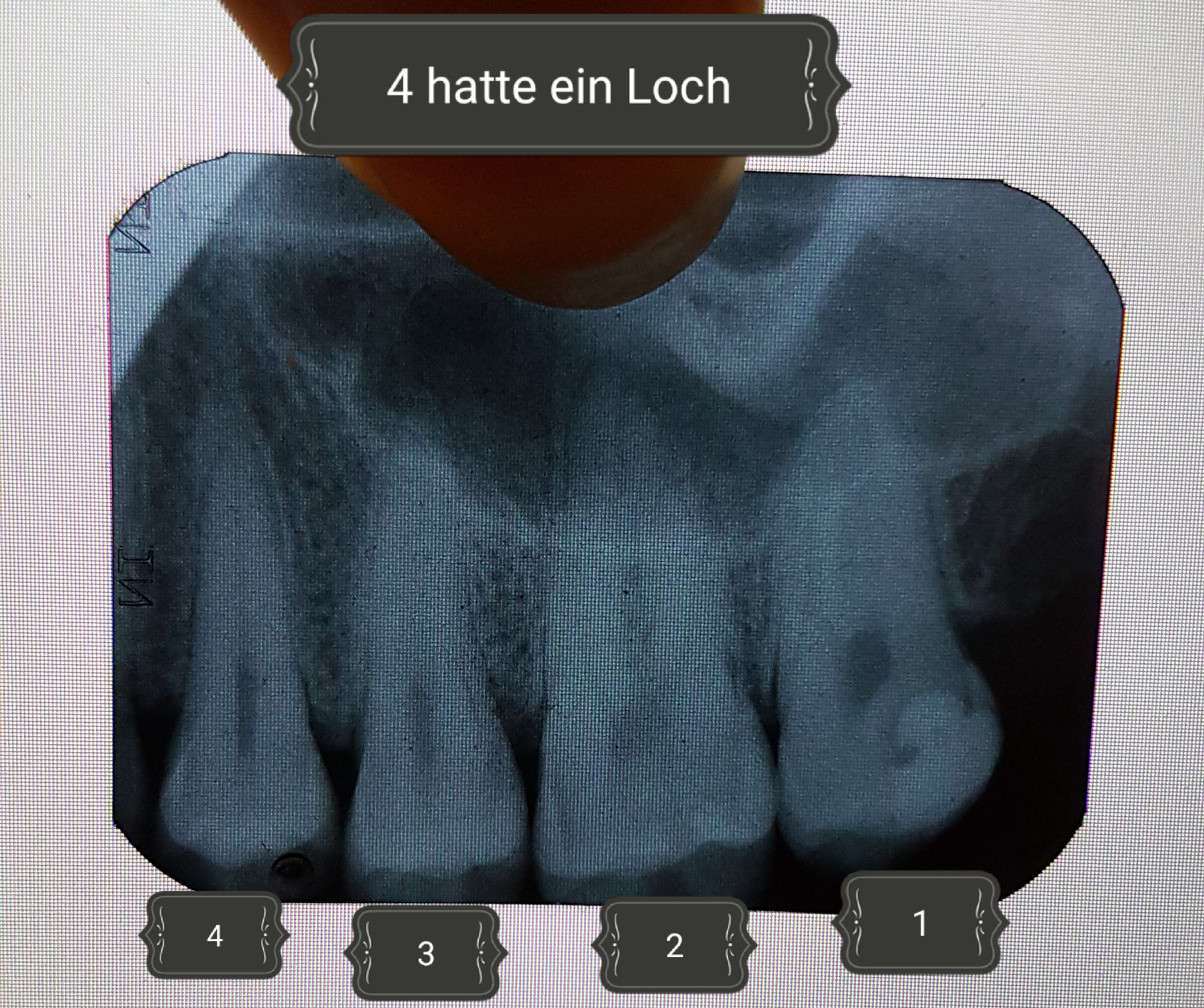 Sieht jmd auf dem Röntgenbild Karies? (Gesundheit und Medizin, Zahnarzt