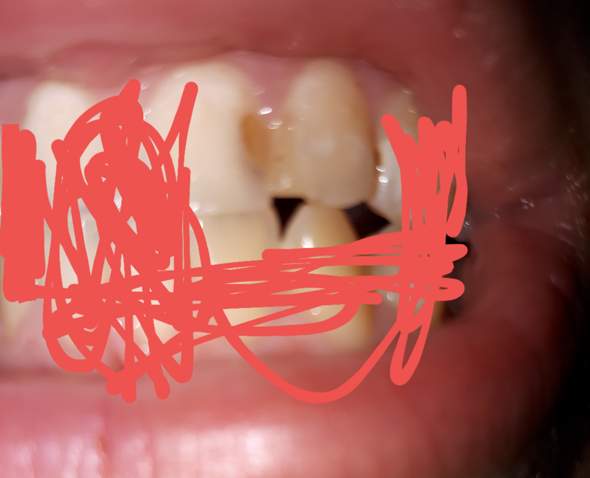 Rausgefallen wurzelbehandlung provisorische füllung Meine provisorische