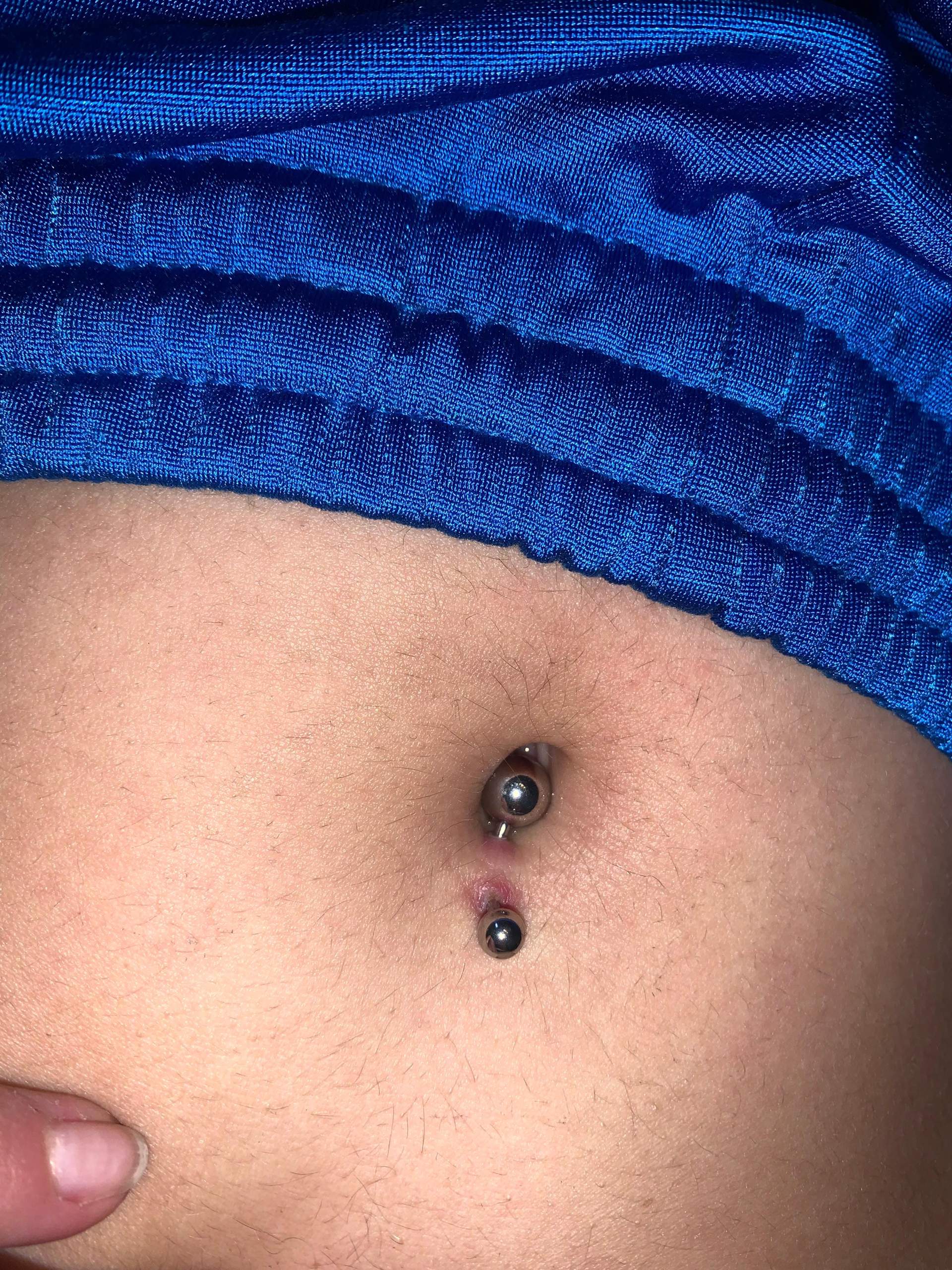 Bauchnabelpiercing Eitert Aber Tut Nicht Weh Sieht mein Bauchnabelpiercing normal aus? (Piercing, Entzündung