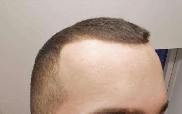 Sieht Mein Haarausfall Mit Schon Sehr Hasslich Aus Gesundheit Und Medizin Gesundheit Frauen