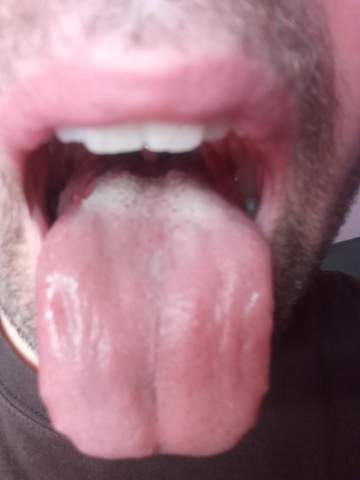 Sieht meine Zunge normal aus?