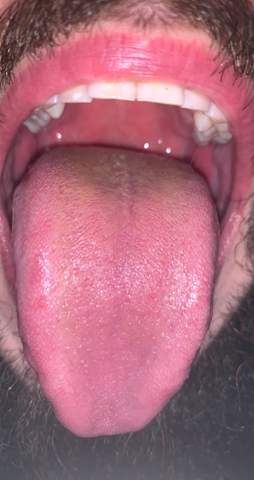 Sieht meine Zunge normal aus? (GELB)?