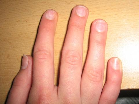 meine rechte hand - (Schwangerschaft, Pilze, Fingernägel)