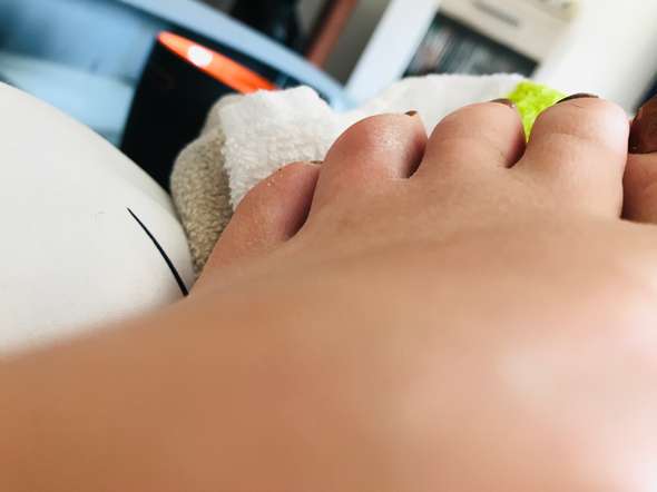 Sieht So Ein Gebrochener Zeh Aus Gesundheit Fusse Knochenbruch Sieht So Ein Gebrochener Zeh Aus Gesundheit Fusse Knochenbruch