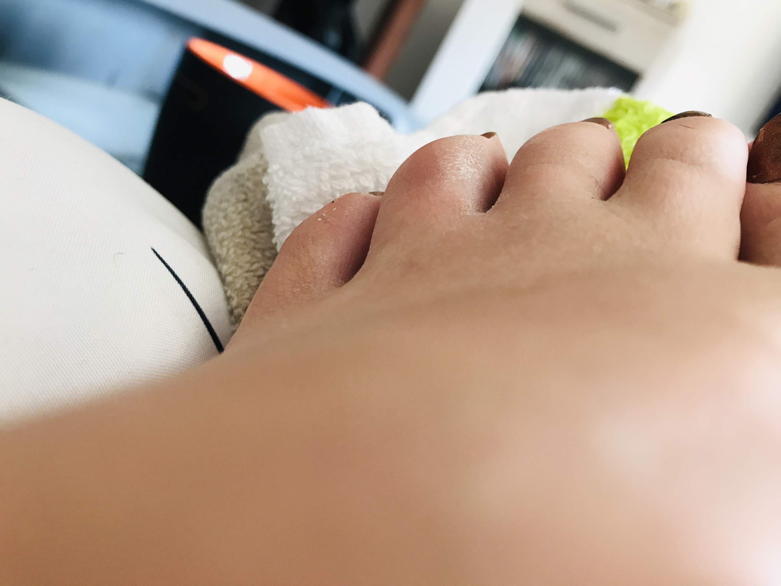 Sieht So Ein Gebrochener Zeh Aus Gesundheit Fusse Knochenbruch Sieht So Ein Gebrochener Zeh Aus Gesundheit Fusse Knochenbruch