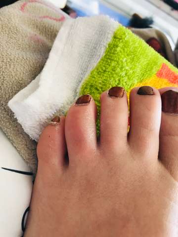 Sieht So Ein Gebrochener Zeh Aus Gesundheit Fusse Knochenbruch Sieht So Ein Gebrochener Zeh Aus Gesundheit Fusse Knochenbruch