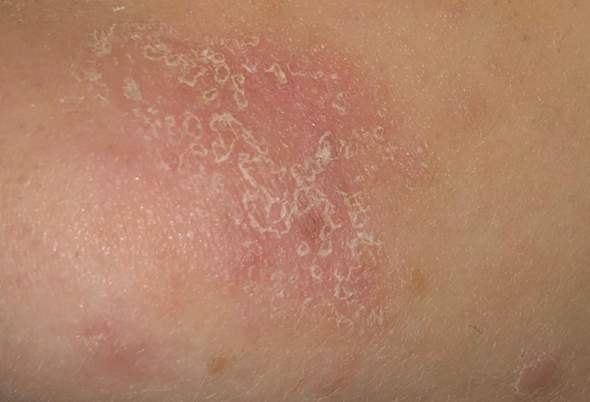 Sieht So Ein Hautpilz Aus Gesundheit Und Medizin Haut Hautpflege