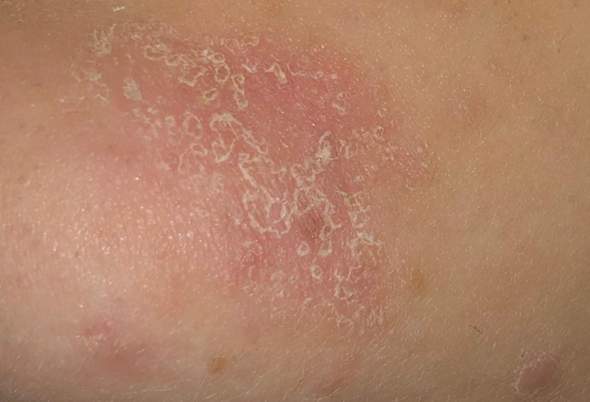 Ansteckend kleienpilzflechte Pityriasis versicolor