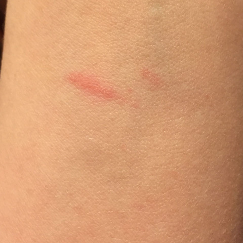 Sieht So Eine Blutvergiftung Aus Krank Sieht So Eine Blutvergiftung Aus Krank