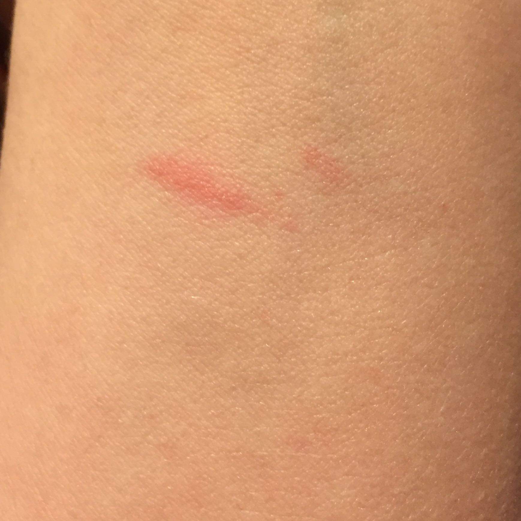 Sieht so eine Blutvergiftung aus? (krank)