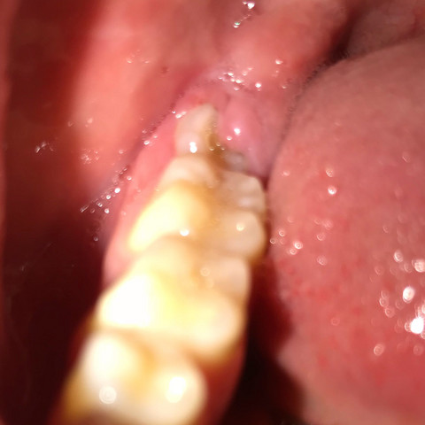 Mein Mund :) - (Gesundheit und Medizin, Zähne, Operation)