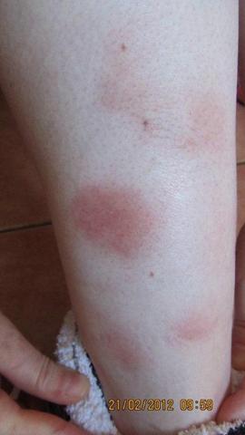 Rote Flecken am Bein 2# - (Arzt, Schmerzen, Thrombose)