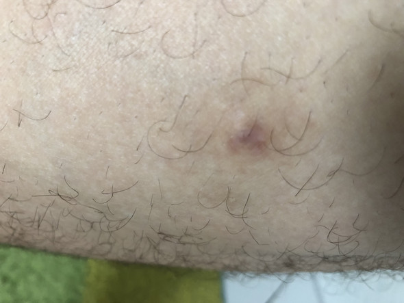 hautprobleme brustwarzen nippel