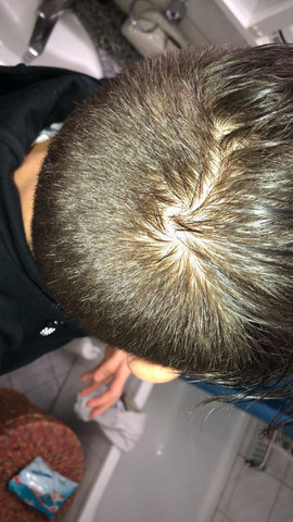 Sind Das Anzeichen Von Haarausfall Gesundheit Haare