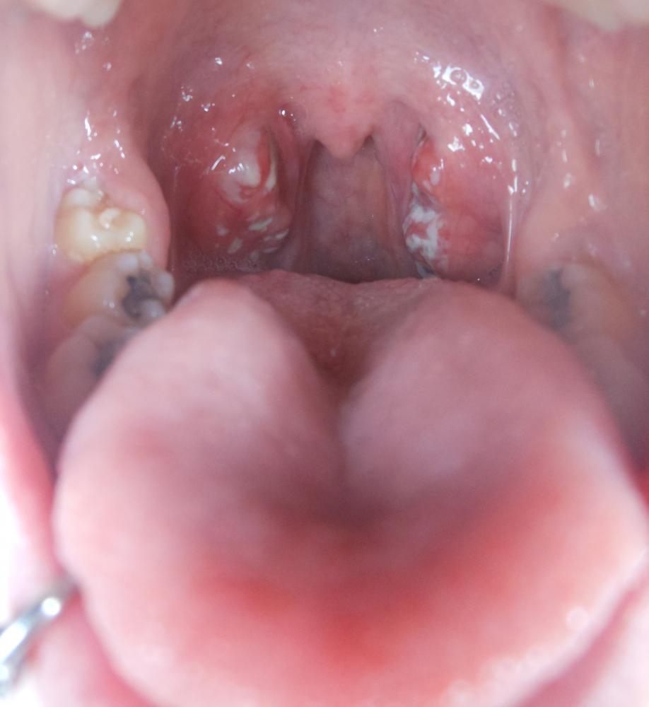 Sind das Aphten? (Gesundheit, Hals)