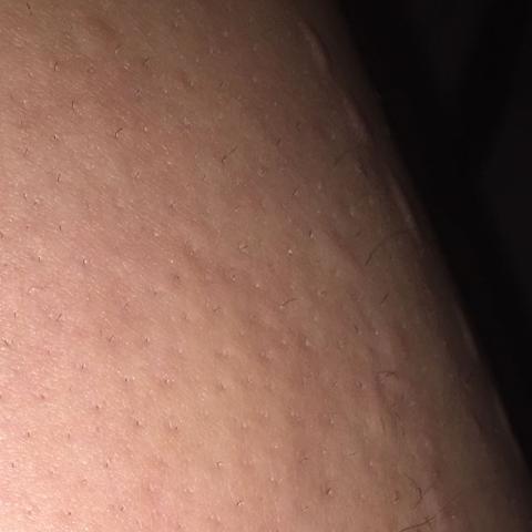 Sind Das Stiche Von Bettwanzen Oder Was Anderes Juckreiz