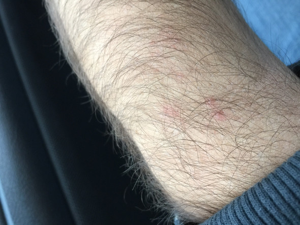 Sind Das Bettwanzen Stiche Gesundheit Und Medizin Insekten Mucken Sind Das Bettwanzen Stiche Gesundheit Und Medizin Insekten Mucken