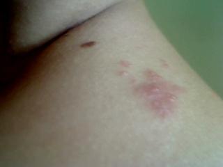 Wie sehen flohbisse aus Wie sehen flohbisse aus