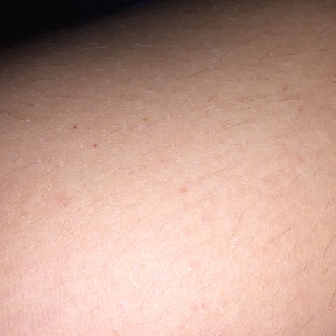 Sind Das Flohbisse Bild Flohe