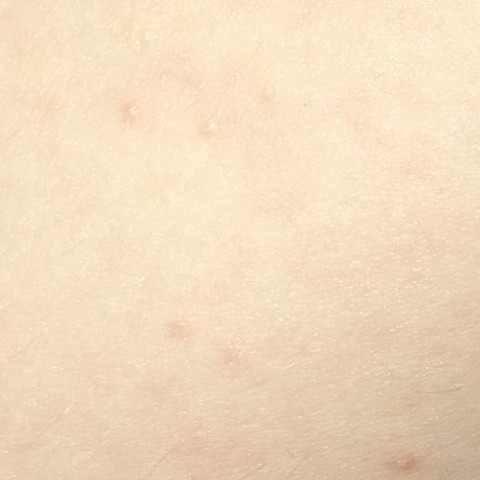 Sind Das Flohstiche An Meinem Bein Gesundheit Gesundheit Und Medizin Katze