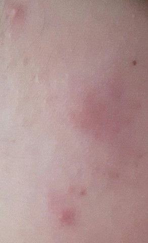 Sind Das Flohstiche Mit Foto Gesundheit Und Medizin Tiere Korper