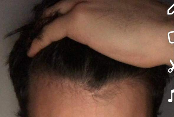 Sind das Geheimratsecken oder ein normaler Haaransatz?