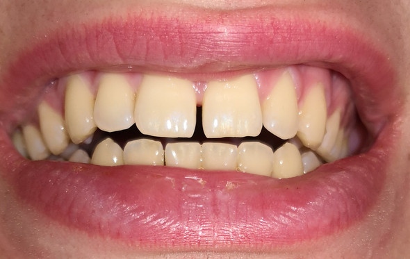 Sind Das Gelbe Zahne Gesundheit Beauty Zahnarzt