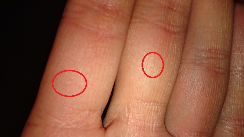 Sind das ggf. werdende Warzen? (Hautpflege)