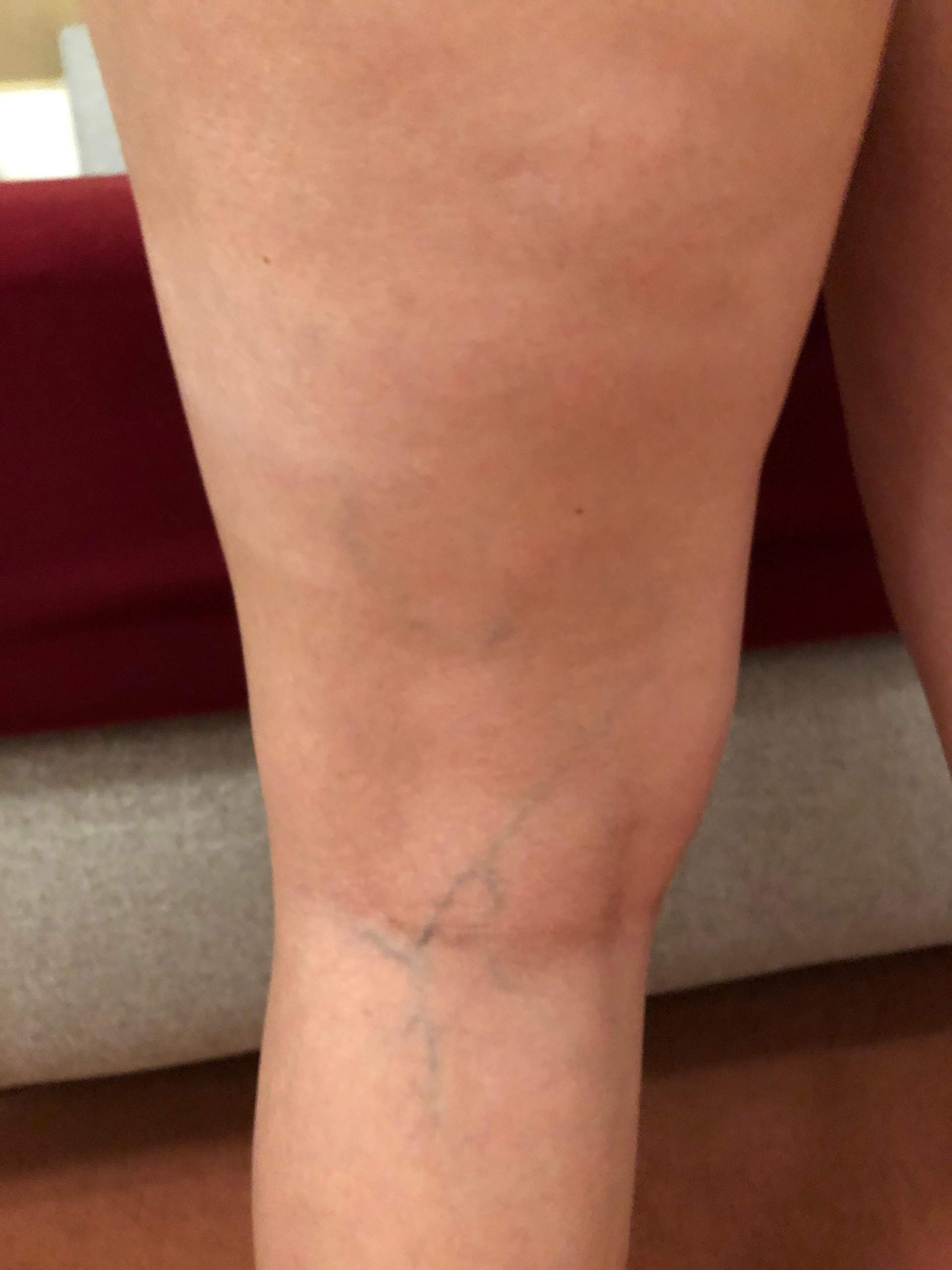 Sind Das Krampfadern Gesundheit Und Medizin Sind Das Krampfadern Gesundheit Und Medizin