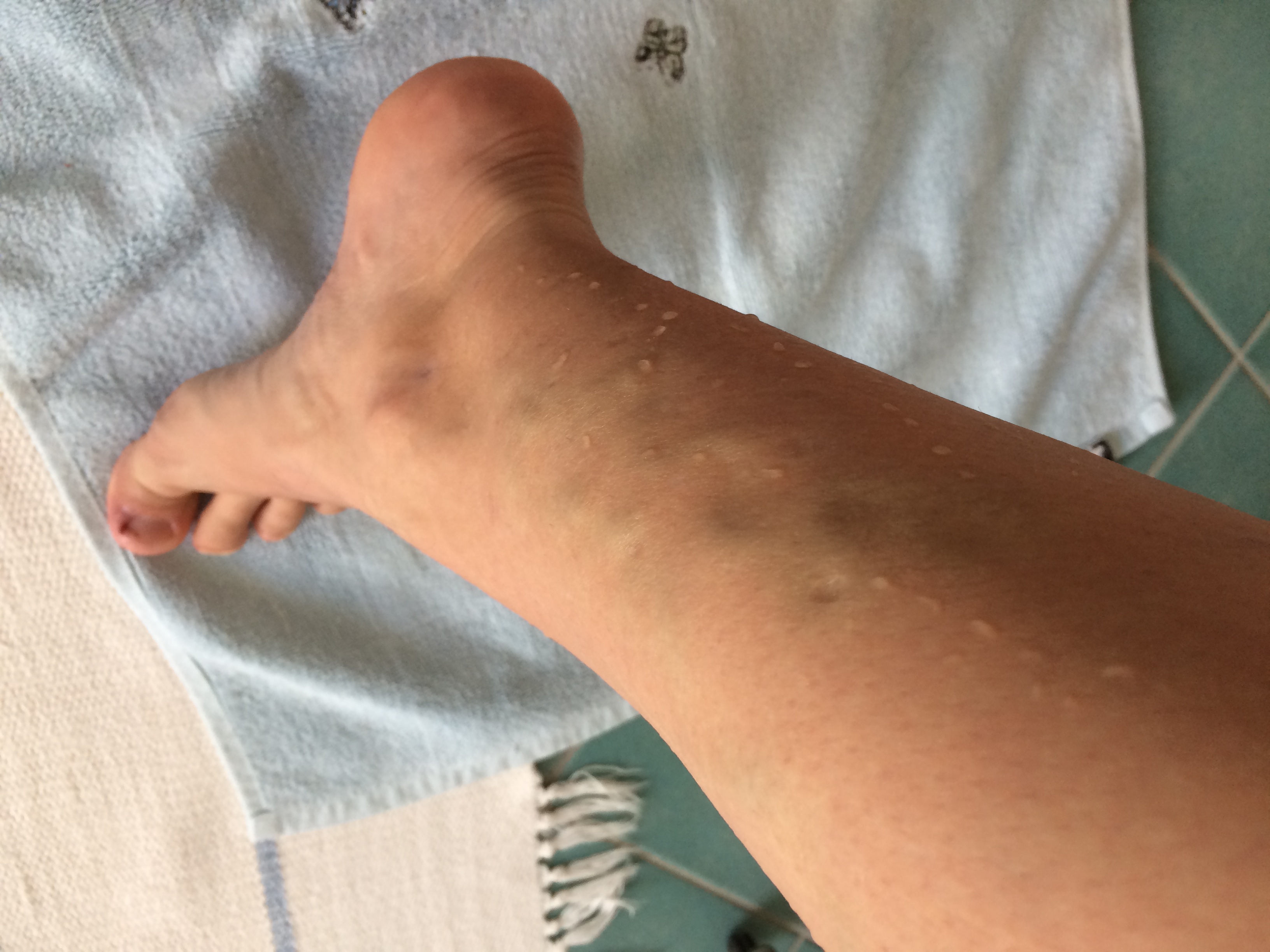 Sind das Krampfadern, oder die Vorstufe davon? (Durchblutung)