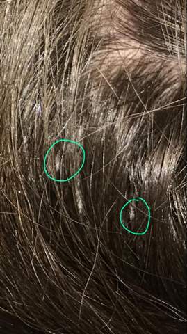 Sind Das Lause In Meinen Haaren Gesundheit Haare Nissen Sind Das Lause In Meinen Haaren Gesundheit Haare Nissen
