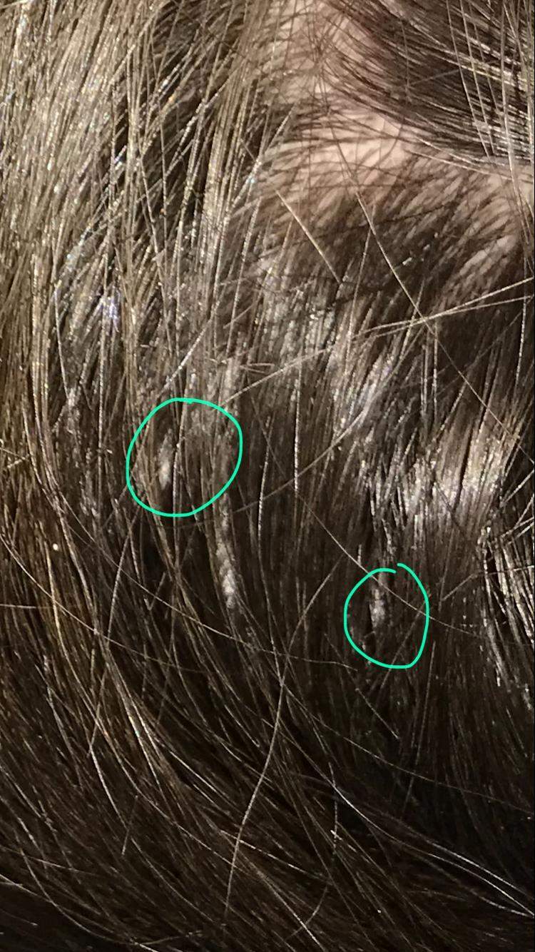Sind das Läuse in meinen Haaren? (Gesundheit, Haare, Nissen)