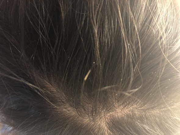 Sind Das Lause Oder Schuppen Gesundheit Haare Kopfhaut Sind Das Lause Oder Schuppen Gesundheit Haare Kopfhaut