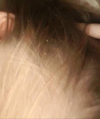 sind das lause oder schuppen bild