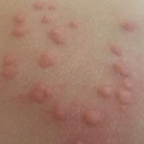 Sind Das Muckenstiche Oder Was 0 Sommer Juckreiz Mucken Sind Das Muckenstiche Oder Was 0 Sommer Juckreiz Mucken