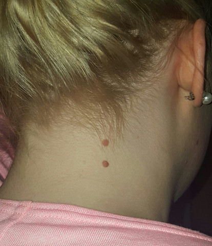 Sind Das Muttermale Oder Warzen Muttermal Sind Das Muttermale Oder Warzen Muttermal