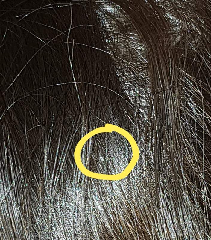 Sind das Nissen in mein Haar? (Haare, Läuse)