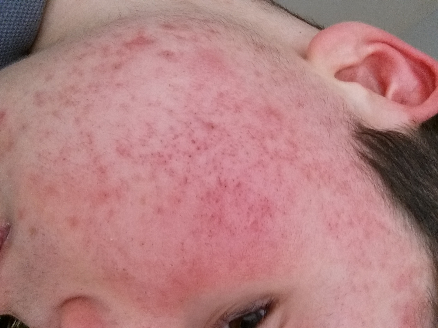 pickel durch zu viel eiweiß pickel durch zu viel eiweiß