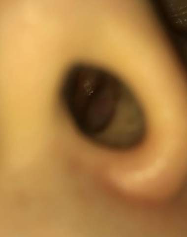 Sind Das Polypen Gesundheit Und Medizin Nase Sind Das Polypen Gesundheit Und Medizin Nase