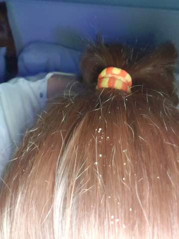 sind das schuppen in den haaren