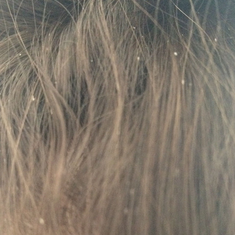 sind das schuppen styling ruckstande