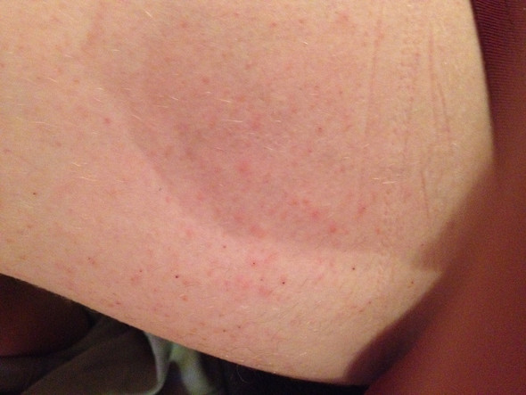 Sind Das Symptome Vom Thrombozytopenie Gesundheit Und Medizin Blut Thrombozyten Sind Das Symptome Vom Thrombozytopenie Gesundheit Und Medizin Blut Thrombozyten