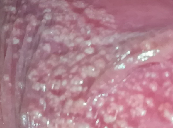 Sind Das Talgdrusen Die Dafur Verantwortlich Sind Dass An Der Innenseite Meiner Schamlippe Weisse Punkte Sind Gesundheit Und Medizin Pflege Vagina Sind Das Talgdrusen Die Dafur Verantwortlich Sind Dass An Der Innenseite Meiner Schamlippe Weisse Punkte Sind Gesundheit Und Medizin Pflege Vagina